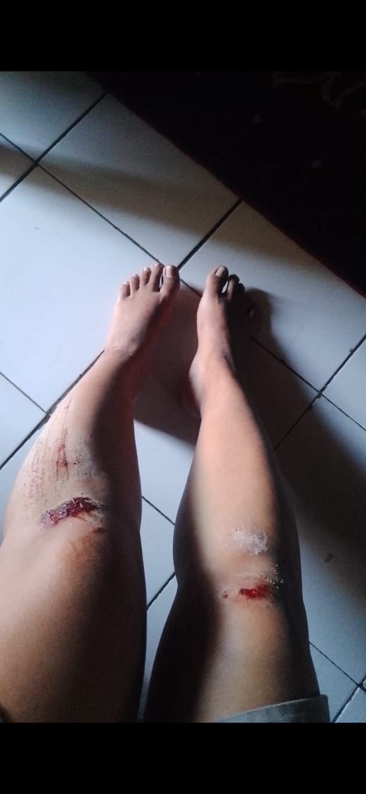 Kejam, Suami Diduga Kuat Aniaya Istri Hingga Terluka Parah di Seluruh Tubuh