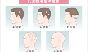 alopecia_img.webp
